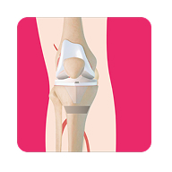 Total Knee Replacement